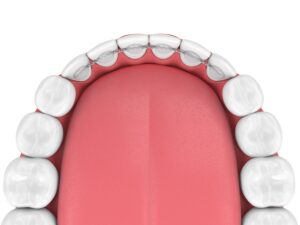 Urgent Dental Clinic in Detroit - Broken Dental Appliance Treatment
